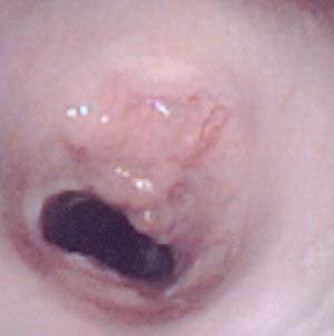 Figur 1  Endoskopisk foto av adenoid cystisk karsinom i trachea