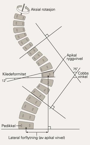Skjematisk fremstilling av de forskjellige variablene som kan måles på røntgenbildet av den skoliotiske ryggsøylen. Aksial…