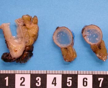 Figur 1 Makroskopisk bilde av mucinøst cystadenom i appendix. Divertikkel i appendix er ikke gjengitt på bildet