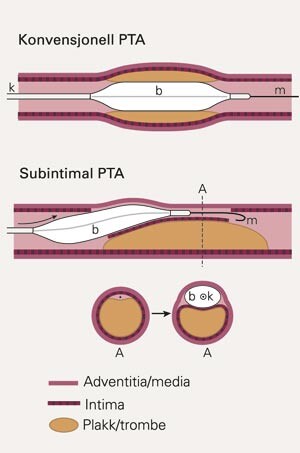 Skjematisk fremstilling av perkutan transluminal angioplastikk (PTA). Øverst konvensjonell PTA. Under vises subintimal PTA,…