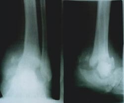 Figur 3  Røntgenbildet av en Charcot-fot. Fotskjelettet har kollapset i mellom- og bakfoten og ankel. Økt trykk over disse…