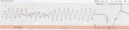 Figur 2 Hos pasient 2 viste utskrift fra defibrillator polymorf ventrikkeltakykardi