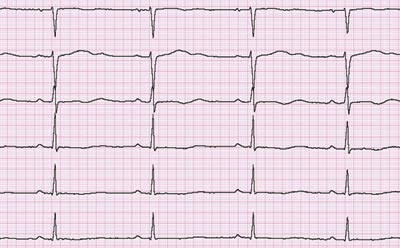 Figur 4 Tydelig forlenget QT-tid på EKG av pasient 2 noen dager etter innkomst. Korrigert QT-tid (QTc) var 562 ms