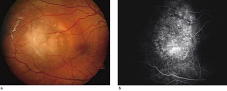 Figur 2  Pasient 3, høyre øye. a) Avgrenset lesjon med koroidal inflammasjon og subretinalt ødem temporalt for macula. b)…