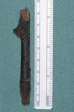 Figur 2  En kvist som målte 8,5 cm, ble fjernet ved det kirurgiske inngrepet