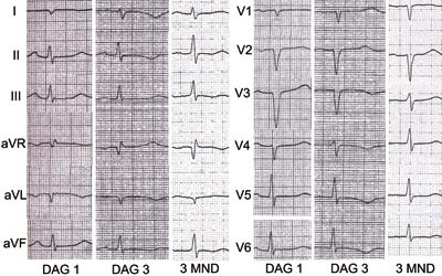 Figur 2  Elektrokardiografi (pasient 3). EKG viser sinusrytme og R-tap i avledningene I, AVL og V₁ – V4 samt negative T…