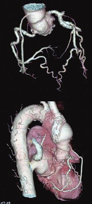 Figur 2  CT-undersøkelse av kransarterier og aorta hos pasient med bypass. Fra Rikshospitalet