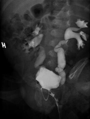 Figur 1 Pasient 1 med bilateral dilatert vesikoureteral refluks