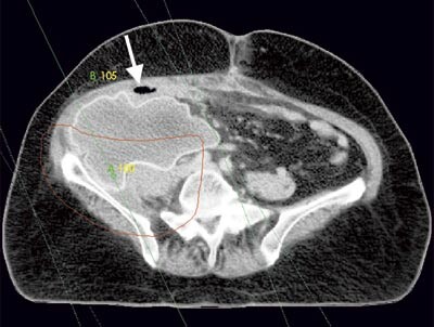 Figur 3  Implantert protese etter reseksjon av tumor. Markerte strålefelter (grønne linjer) og målvolum (rød linje)…