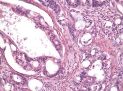 Figur 1 Eksempel på histopatologisk bilde ved duktalt adenokarsinom i pancreas (hematoksylin-eosin-farging, forstørret 200…