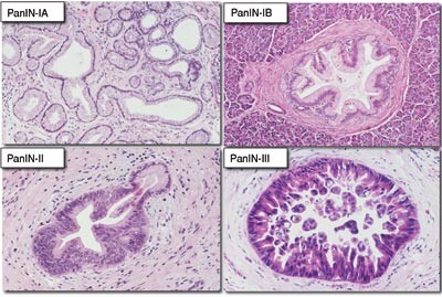 Figur 2 Histopatologiske bilder ved ulike grader av pankreatisk intraepitelial neoplasi (PanIN). For beskrivelse se tabell…