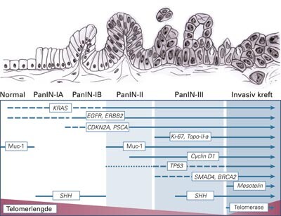 Figur 3 Progredieringsmodell for utvikling av duktalt adenokarsinom i pancreas via PanIN-forstadier. Pilene antyder ved…