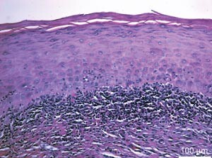 Figur 2  Biopsi av en lichenoid reaksjon i munnslimhinnen i topografisk relasjon til en amalgamfylling. Bemerk keratose på…
