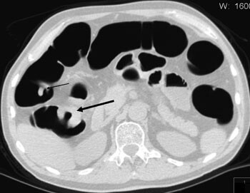 Figur 2 Pasient henvist til CT-kolografi etter inkomplett koloskopi grunnet en strikturerende prosess. Dette var en tumor,…