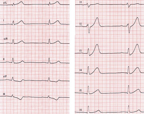 Figur 1 EKG ved innkomst viste normofrekvent sinusrytme med ST-depresjon og dels T-inversjon i aVF og III, høye T-takker i…