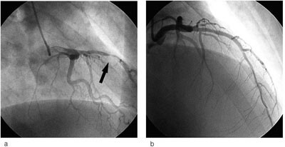 Figur 2 a) Koronar angiografi viste generelle veggforandringer samt 90 % stenose i midtre LAD. b) Denne ble PCI-behandlet…