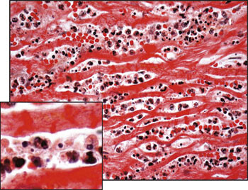 Figur 4  Histologisk preparat som til sammenlikning viser akutt hjerteinfarkt. Det er rikelig infiltrasjon av granulocytter…