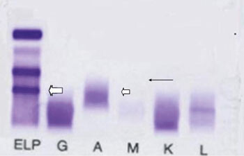 Figur 2  Serumimmunfiksasjonselektroforese. Påvisning av små mengder av komplett IgG-κ katodisk i γ -sonen (⇐) og…