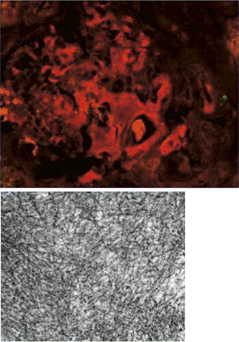 Figur 4  Øverste bilde viser glomerulære nedslag av anti-λ-positivt materiale (rødt) ved immunfluorescens. Nederste bilde…