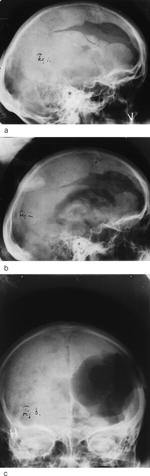 Figur 2  De tre r&oslash;ntgenbildene av pasienten som Monrad-Krohn publiserte bl.a. i tidsskriftet Brain i 1947 (5, 12). a) Bildet&hellip;