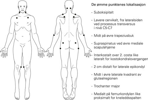 Diagnosekriterier for fibromyalgi etter American College of Rheumatology 1990 (10). Utbredt smerte, dvs. i minst tre…
