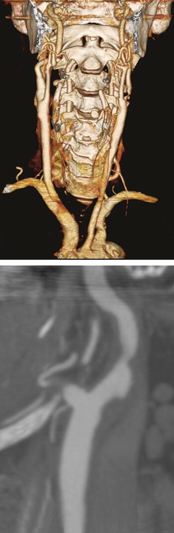 Figur 3  CT-angiografi av halskar, to- og tredimensjonal rekonstruksjon. Foto Rikshospitalet–Radiumhospitalet