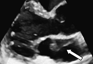 Figur 4   Parasternal langakseavbildning med transtorakal tredimensjonal ekkokardiografi (Vivid 7, GE Vingmed). Membranen i…