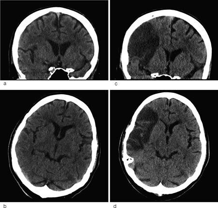 Figur 2  Cerebral CT i a) koronalplan og b) horisontalplan ved innleggelse er tilsynelatende normal, men inneholder et…