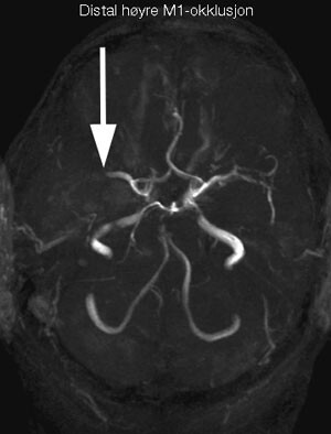 Figur 1 Pilen viser okklusjon av høyre a. cerebri media i det distale M1-segmentet, fremstilt ved MR-angiografi