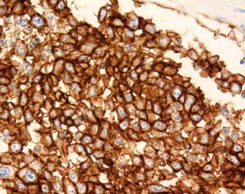 Figur 3  Immunhistokjemisk undersøkelse viser at tumorcellene er positive for B-cellemarkøren CD20, i bildet farget brune (x…