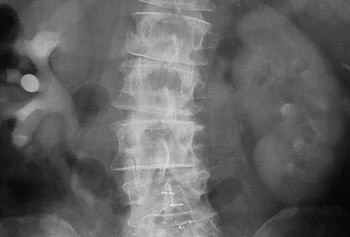 Figur 1  Postoperative urografibilder hos en 73 år gammel mann gjennomgått cystektomi med urinavledning.15-minutters bilde…