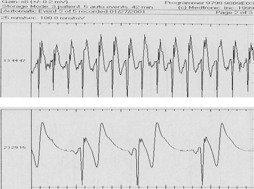 Figur 2 Utskrift fra rytmeovervåkeren viser en episode med supraventrikulær takykardi 180/min (øverst) og bradykardi 42/min…