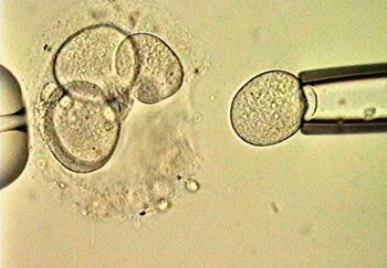 Figur 1  En celle aspireres fra et embryo den tredje dagen etter egguttak for å bli analysert ved hjelp av preimplantatorisk…