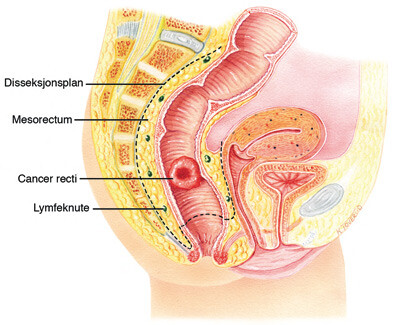 Figur 3 Total mesorektal eksisjon for rectumcancer. Mesorectum, fettvevet som omgir tarmrøret, inneholder bl.a…