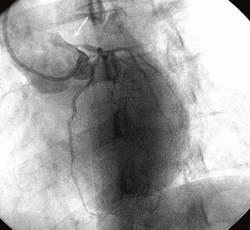 Figur 2  Koronar angiografi av venstre koronararterie der venstre hovedstamme har en uttalt stenose (pil)