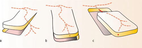 Figur 1  a) Tilfeldig lapp (random flap) høstes uavhengig av blodforsyningens retning. b) Aksial lapp. Retningen planlegges…