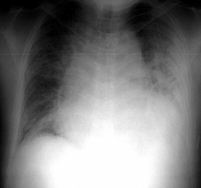 Figur 2  Røntgen thorax ved innkomst på sykehuset viste en forstørret hjerteskygge og forandringer forenlig med lungestuvning