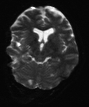 Figur 1  MR av cerebrum, diffusjonsvektet serie, viser små foci med diffusjonsrestriksjon i begge cerebrale og cerebellare…