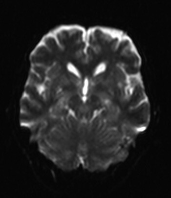 Figur 2  MR av cerebrum, diffusjonsvektet serie, tatt en uke senere viser at de bilaterale foci med diffusjonsrestriksjon i…