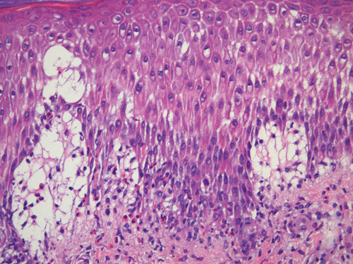 Figur 3  Histologisk prøve av utslett viser spongiose i epidermis med uttalt ødem i papillære dermis. Det er økt antall…