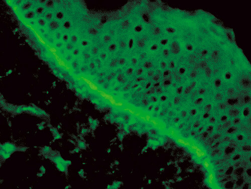 Figur 4  Immunfluorescens av utslett viser tydelige lineære nedslag av C3 langs basalmembranen
