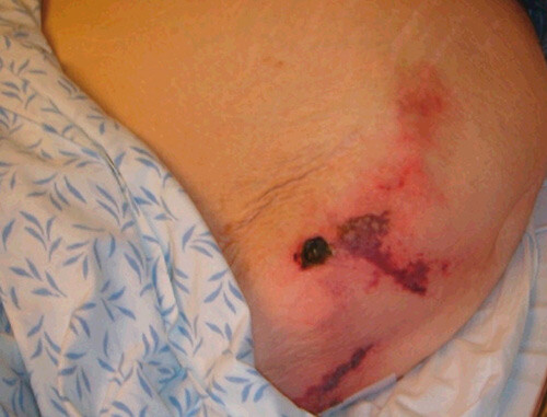 Figur 1  Hudforandringer på abdomen, åtte uker ante mortem. Foto Eystein J. Hauge, Avdeling for plastikkirurgi, Haukeland…