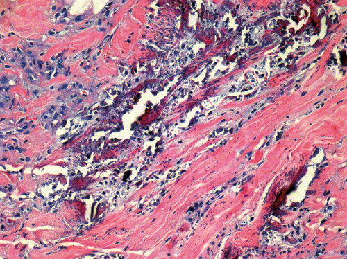 Figur 2  Histologiske forandringer i hudbiopsi tatt fra pasienten åtte uker før hun døde. Det ses forkalkninger i…