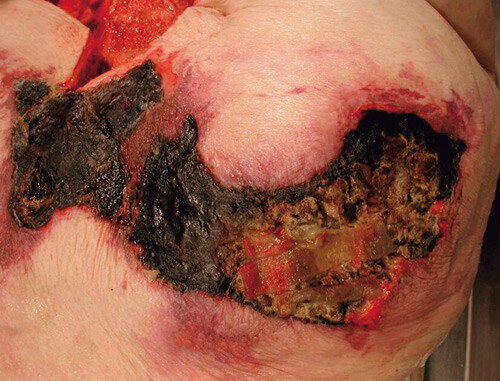 Figur 3  Kalsifylaksi og nekroser i huden over abdomen, fotografert ved obduksjonen. Området målte nå 20 x 30 cm