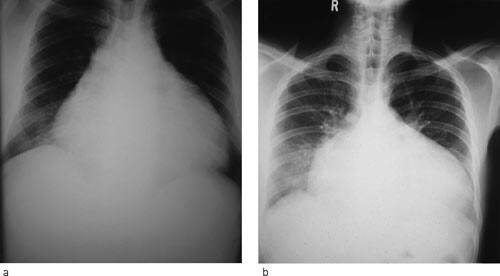 Figur 1 Kardiomegali ved a) perikardeffusjon og ved b) dilaterende kardiomyopati. Røntgen thorax alene er ikke…