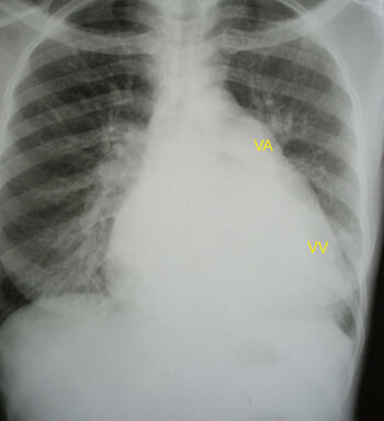 Figur 3 Røntgen thorax av kvinne 20 år med kombinert mitral stenose/insuffisiens. Hjertesilhuett viser dilatert venstre…