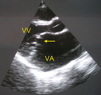 Figur 4 Parasternal langakse av samme pasient (fig 3). Mitral stenose/insuffisiens med under 1 cm åpning mellom stive…