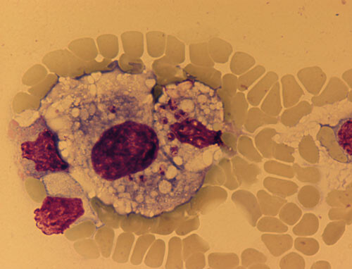 Figur 1  Beinmargsaspirat (giemsa, x 1000): 3 – 4 µm store leishmaniaamastigoter med tydelig kjerne og kinetoplast som…