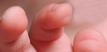 Horisontale furer på fingertuppene kan være et diagnostisk tegn. © Elsevier 2007 (1)