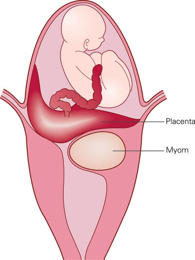 Figur 3 Skjematisk fremstilling av de anatomiske forandringene i uterus, der et intramuralt myom muligvis forårsaket deling…